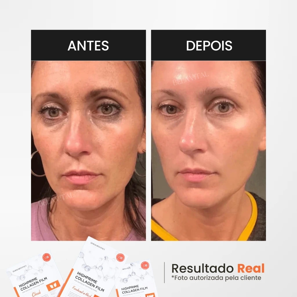 Kit  GoldBotox Highprime - Colágeno + Ácido Hialurônico + Ativos do Botox